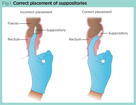 anal checkup|Rectal examination .